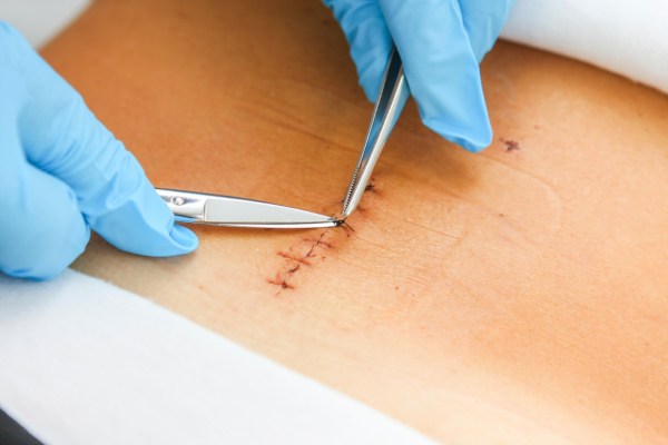 Evde dikiş alma ve infüzyon bakımı